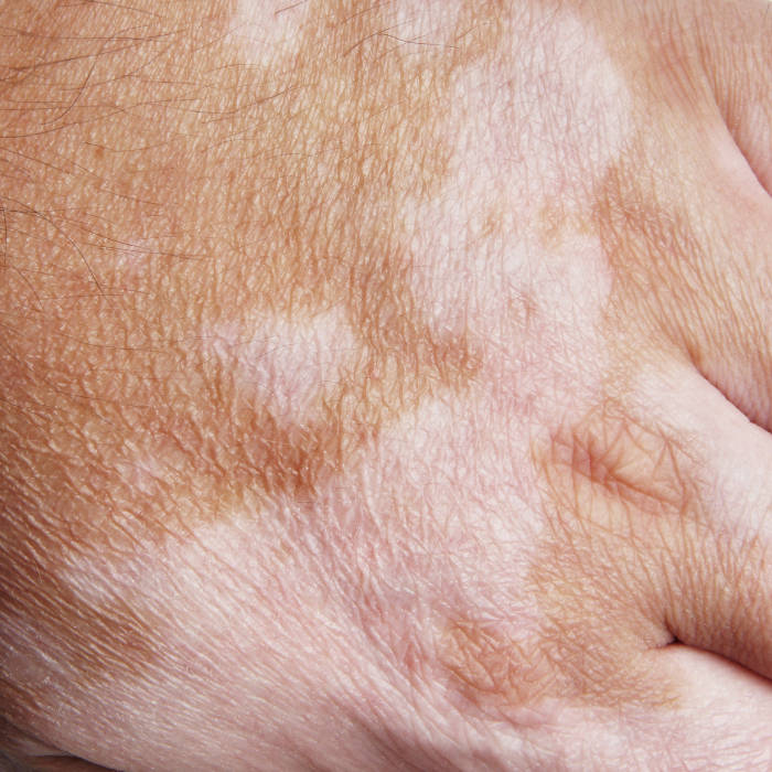 Elektrosmog wpływ na skórę